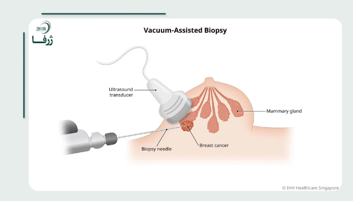مزایای وکیوم بیوپسی پستان 