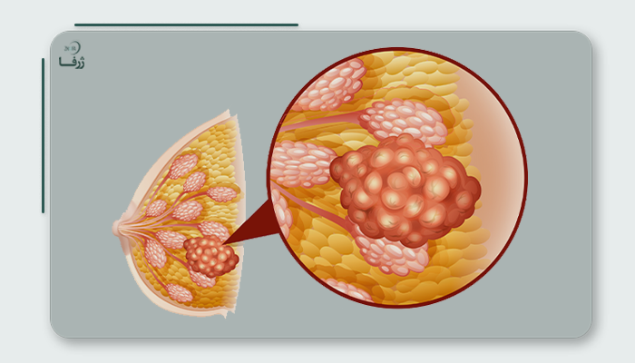 تعریف تومور سینه 